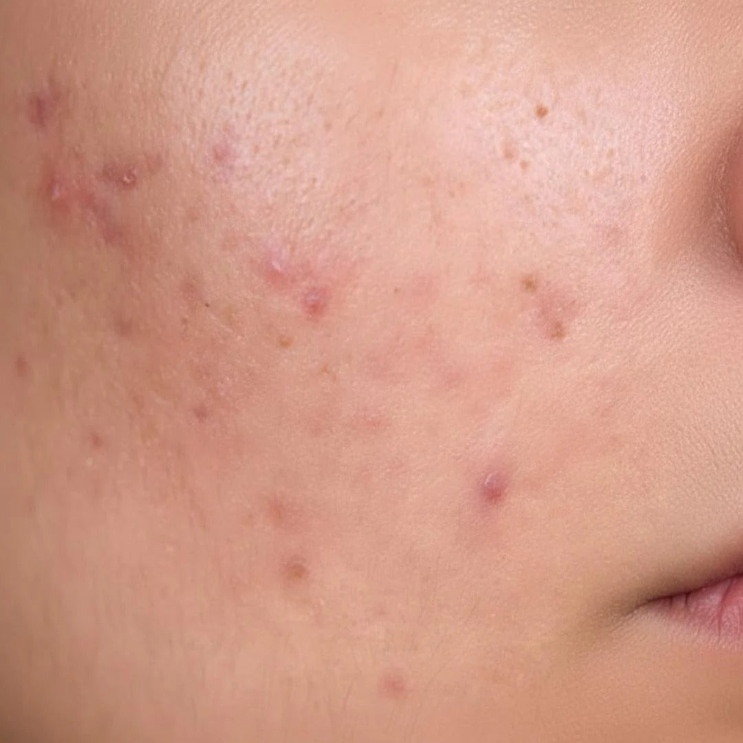 Skin breakouts